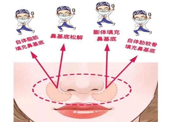 自體脂肪豐鼻基底多久自然  http://www.sanboo.cn
