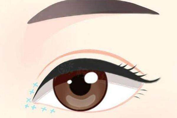 全切雙眼皮比較好的醫(yī)院