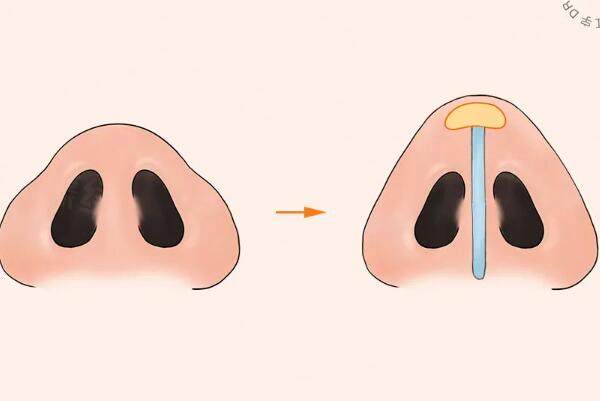 寬鼻矯正多少錢