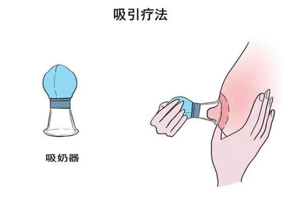 乳頭內(nèi)陷.jpg