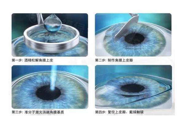 准分子激光2.jpg