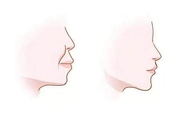 悅齡塑填充鼻基底能保持多久www.sanboo.cn