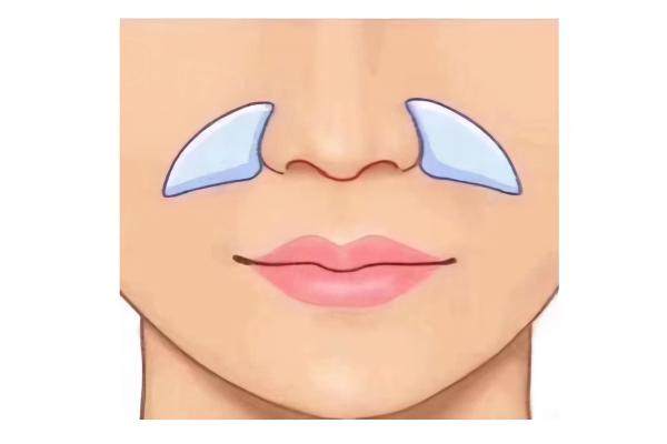 悅齡塑填充鼻基底能保持多久www.sanboo.cn