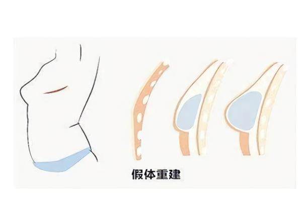 曼托進(jìn)口隆胸是<span style=