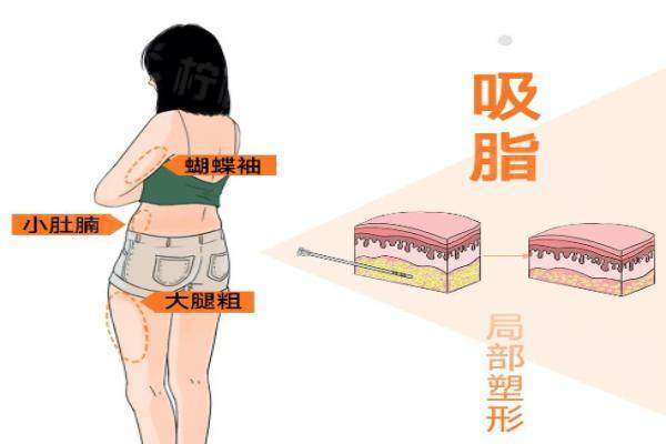 濰坊吸脂手術(shù)哪家比較好www.sanboo.cn