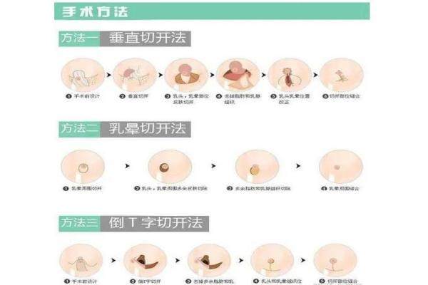 如何縮胸?讓胸變小？可乳房縮小術/脂肪抽吸等手術治療,也可減肥/鍛煉等非手術！okostu.com