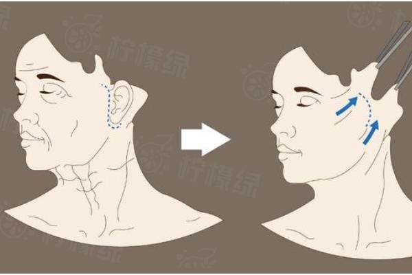 頸紋有哪些醫(yī)美項(xiàng)目可以去除www.sanboo.cn