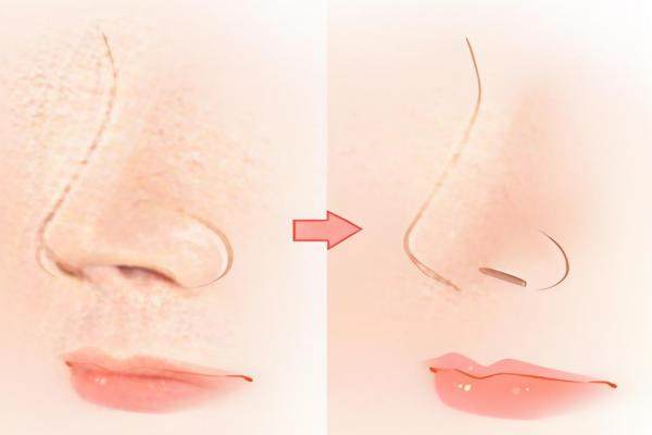 成都鼻整形哪個醫(yī)生技術(shù)好?okostu.com