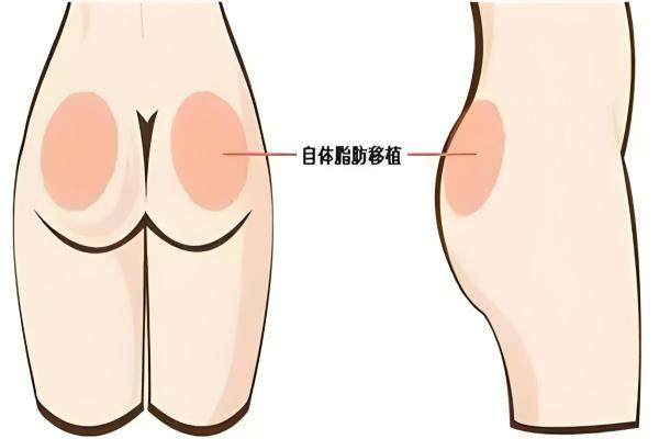 自體脂肪豐臀成效好嗎會吸收嗎?okostu.com