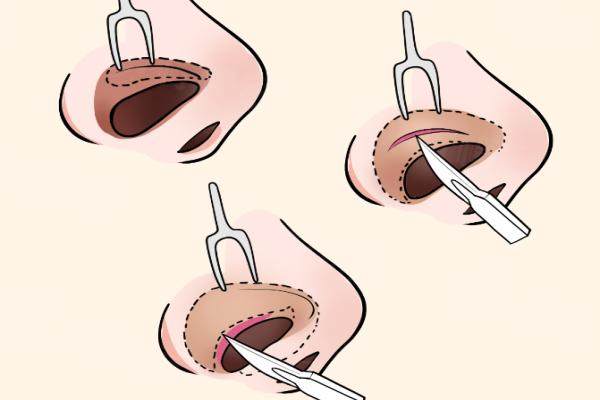 成都鼻整形哪個醫(yī)生技術(shù)好?okostu.com