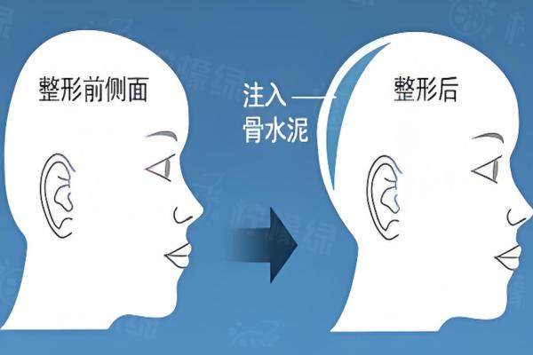 國內(nèi)后腦勺填充的醫(yī)院哪家好okostu.com