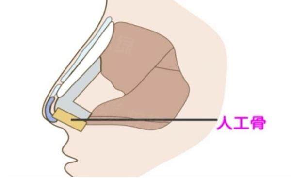葡聚糖隆鼻多少錢一支www.sanboo.cn