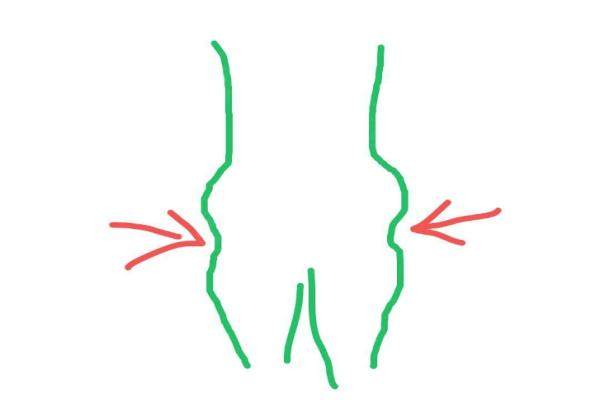 臀部兩側凹陷怎么改善yanke.yadoo.cn