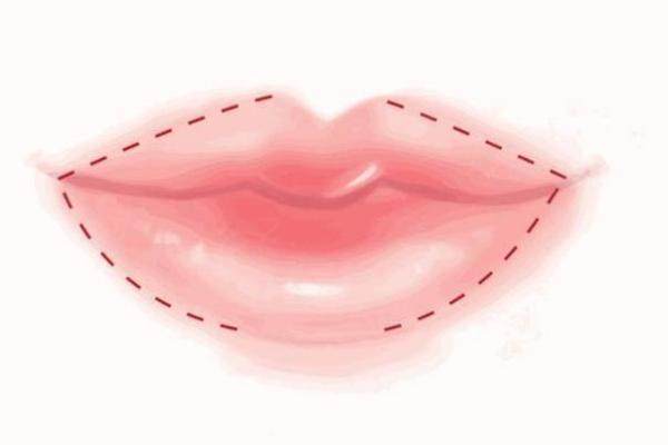 嘴巴打了玻尿酸還可以做m唇嗎www.sanboo.cn