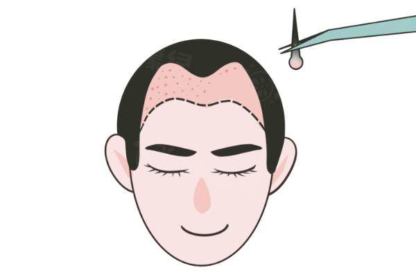 發(fā)際線植發(fā)多久能全部長(zhǎng)出來(lái)www.sanboo.cn