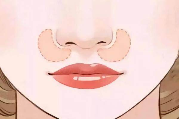 adm填充鼻基底能維持多久www.sanboo.cn