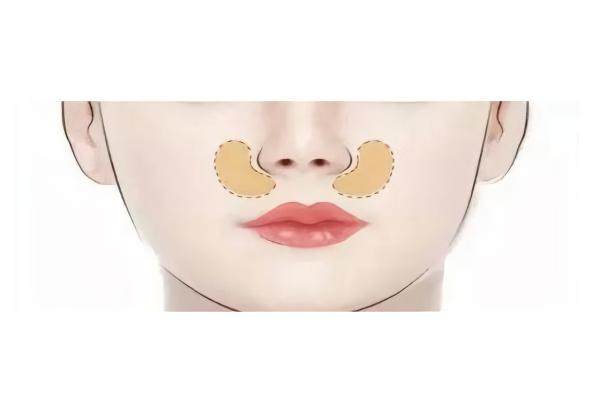 adm填充鼻基底能維持多久www.sanboo.cn