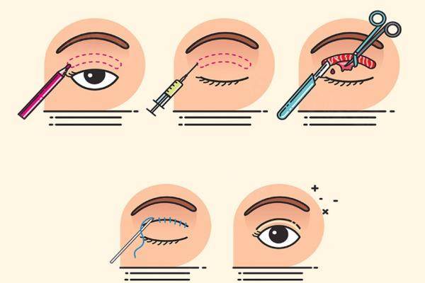 長沙雙眼皮手術(shù)好的醫(yī)生www.sanboo.cn