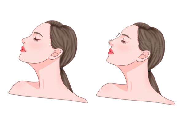 北京美萊王旭東醫(yī)生做鼻子怎么樣?okostu.com