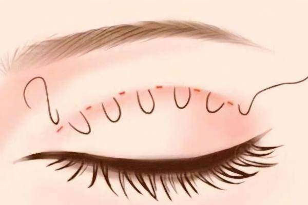 張姣姣雙眼皮做得好嗎www.sanboo.cn