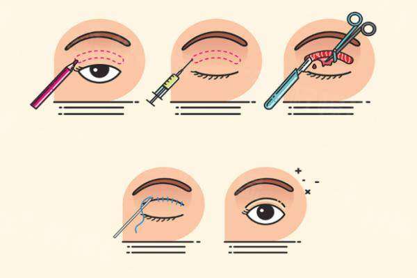張姣姣雙眼皮做得好嗎www.sanboo.cn