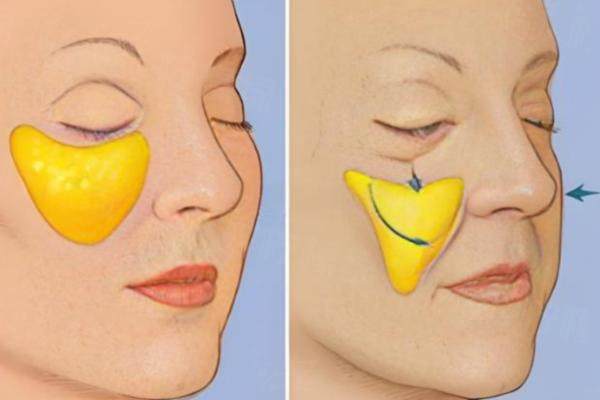 國(guó)內(nèi)蘋果肌復(fù)位十大醫(yī)生排名okostu.com