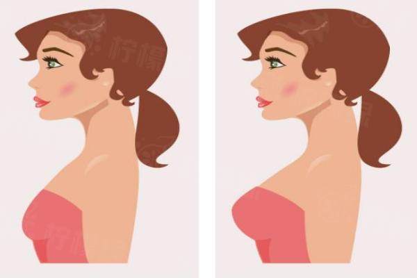 殷初陽醫(yī)生隆胸怎么樣?手感自然，疤痕隱蔽|附真實病例okostu.com