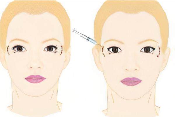 薇旖美三型膠原蛋白打眼周有用嗎www.sanboo.cn