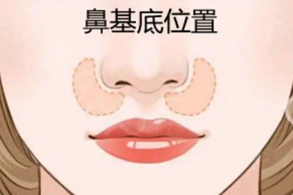 玻尿酸填鼻基底移位了能修復(fù)嗎www.sanboo.cn