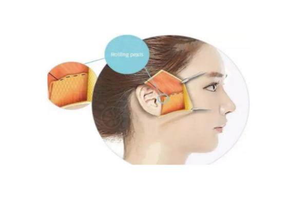 深圳王乙立做無痕筋膜提升技術(shù)怎么樣www.sanboo.cn