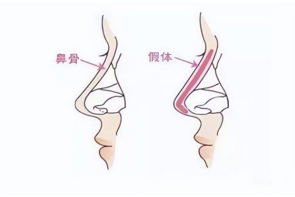 鼻部假體取出可以換成什么材質(zhì)www.sanboo.cn