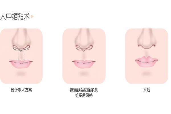 北京做人中縮短手術(shù)有名的醫(yī)生www.sanboo.cn