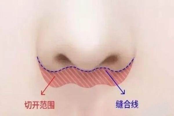 人中縮短手術(shù)對比www.sanboo.cn