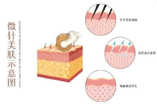 黃金微針幾次一個(gè)療程www.sanboo.cn