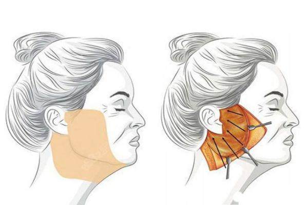 深圳八大處做拉皮怎么樣www.sanboo.cn