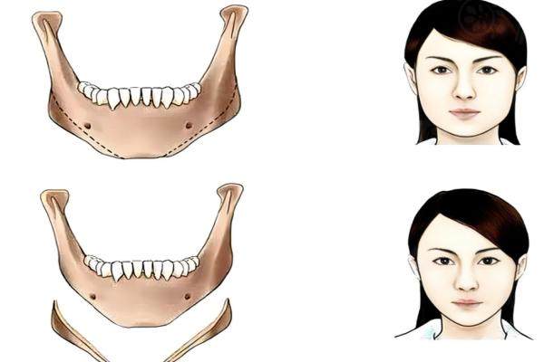 廣州柳超磨骨手術(shù)好嗎？www.sanboo.cn