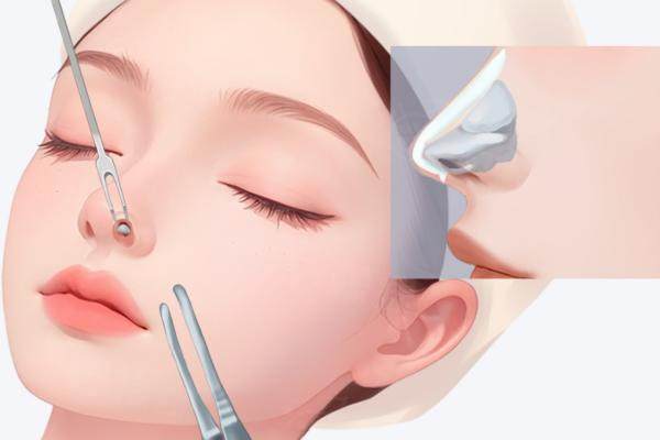 貴陽華美哪位醫(yī)生做鼻子好？www.sanboo.cn