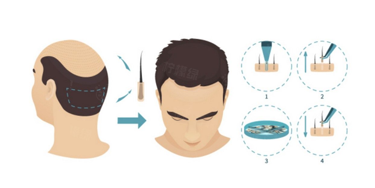 菏澤植發(fā)醫(yī)院哪家好？www.sanboo.cn