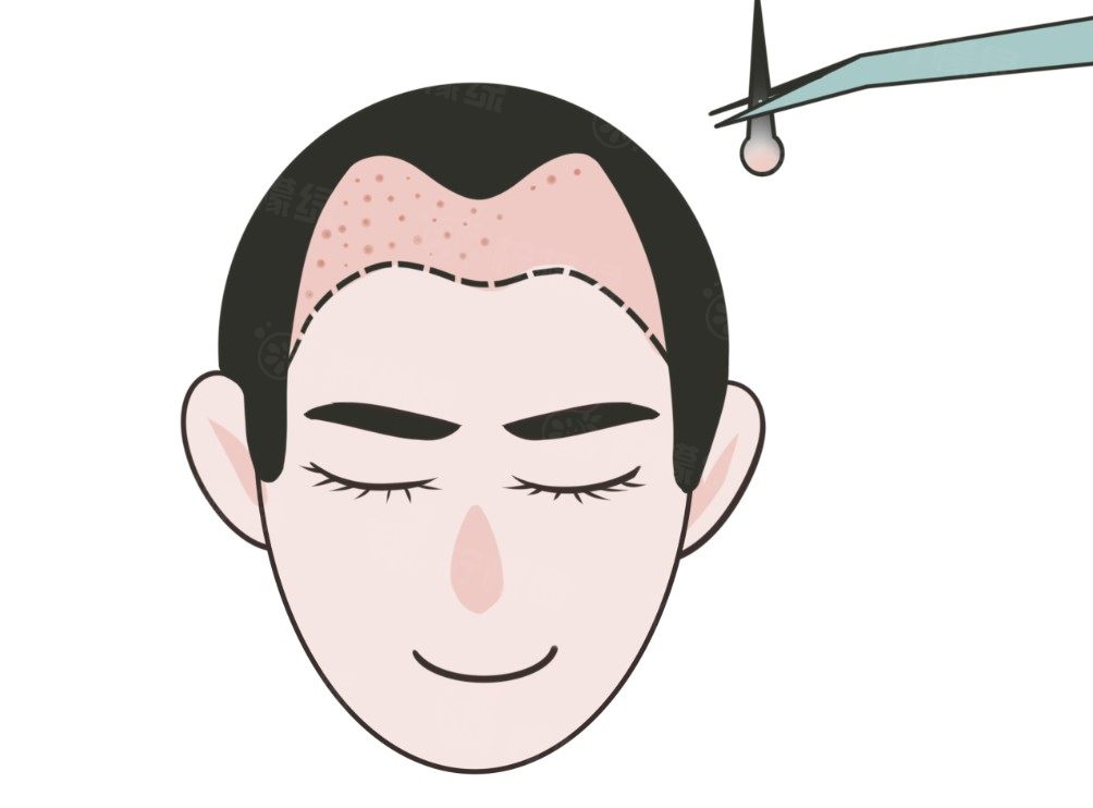 菏澤植發(fā)醫(yī)院哪家好？www.sanboo.cn