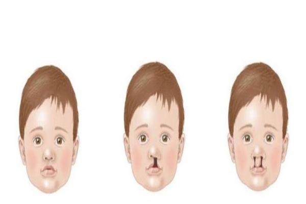 唇腭裂修復(fù)手術(shù)大概需要多少費(fèi)用www.sanboo.cn