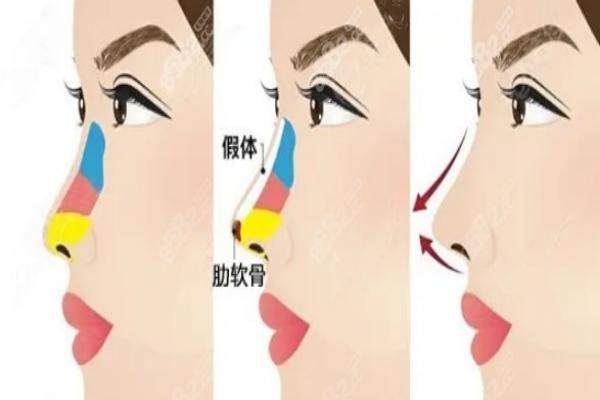 長沙雅美田芳斌隆鼻價格www.sanboo.cn