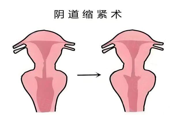 八爪鱼紧缩术和3d生物束带一样吗