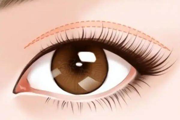 沈陽(yáng)陳軍雙眼皮修復(fù)醫(yī)院