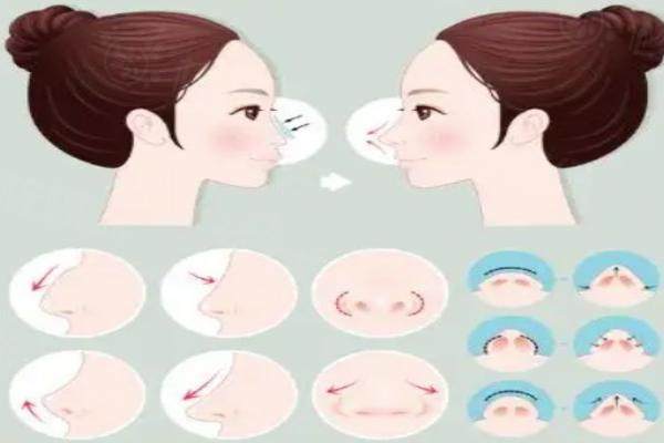 胡柏醫(yī)生隆鼻<span style=