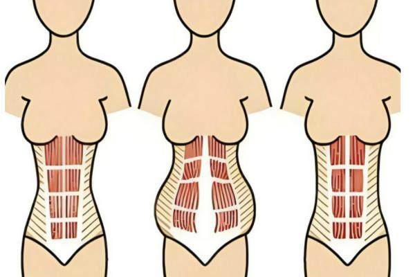 崔鑫腹壁整形多少錢