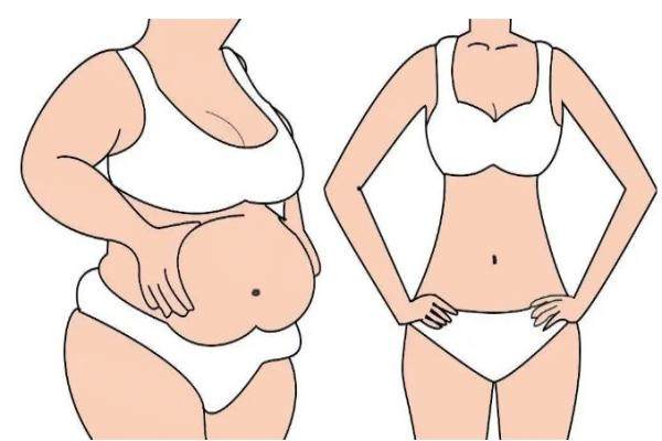 崔鑫腹壁整形多少錢