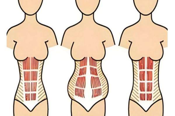 崔鑫腹壁整形多少錢