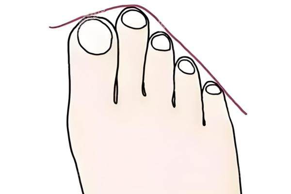 二腳趾縮短微創(chuàng)手術風險大嗎