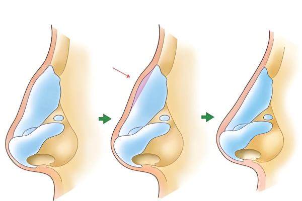 取完鼻假體怎么預(yù)防攣縮