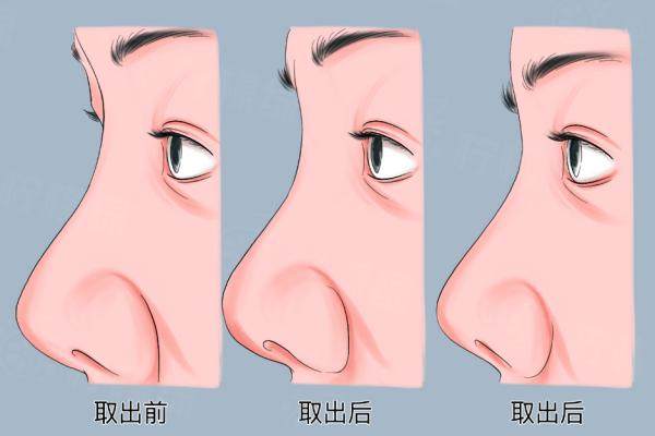 取完鼻假體鼻頭攣縮攣縮鼻會(huì)一直縮嗎
